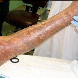 box jellyfish wounds 10yr old exiledonline.com