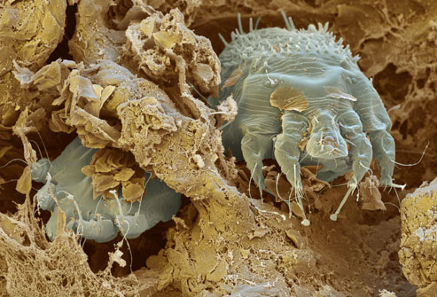 Scabies: My Parting Gift from Los Angeles' Metro Jail
